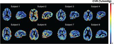 Sinusoidal CO2 respiratory challenge for concurrent perfusion and cerebrovascular reactivity MRI